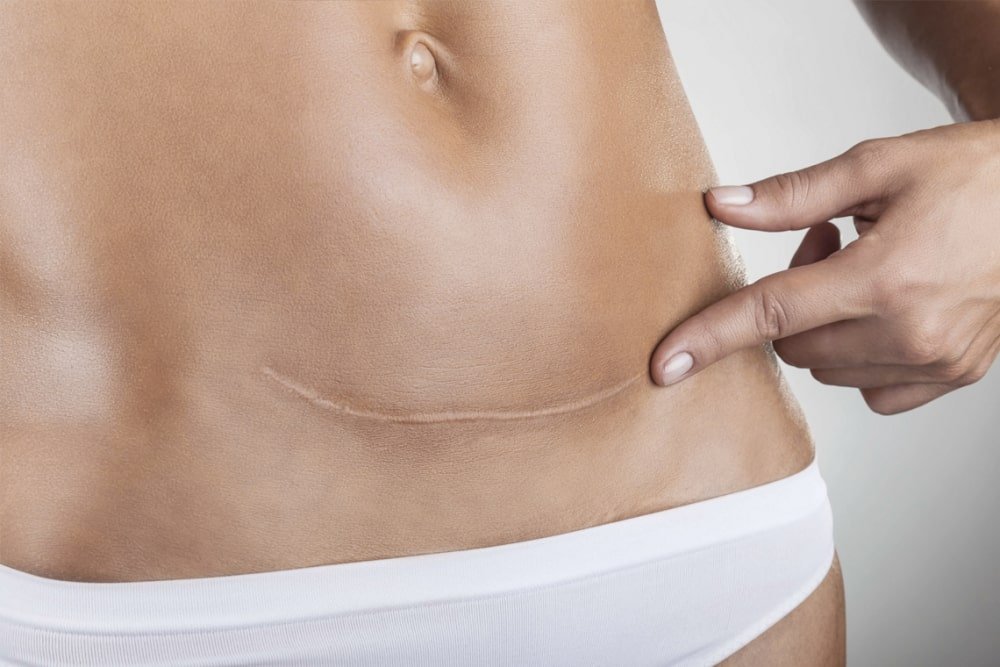 cicatriz de la cesarea