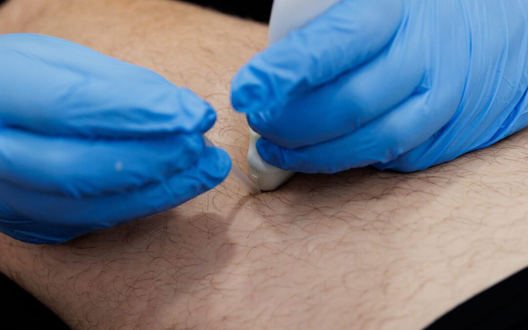 Punción seca para el dolor de cuello y la cefalea tensional: cómo funciona y cuándo conviene