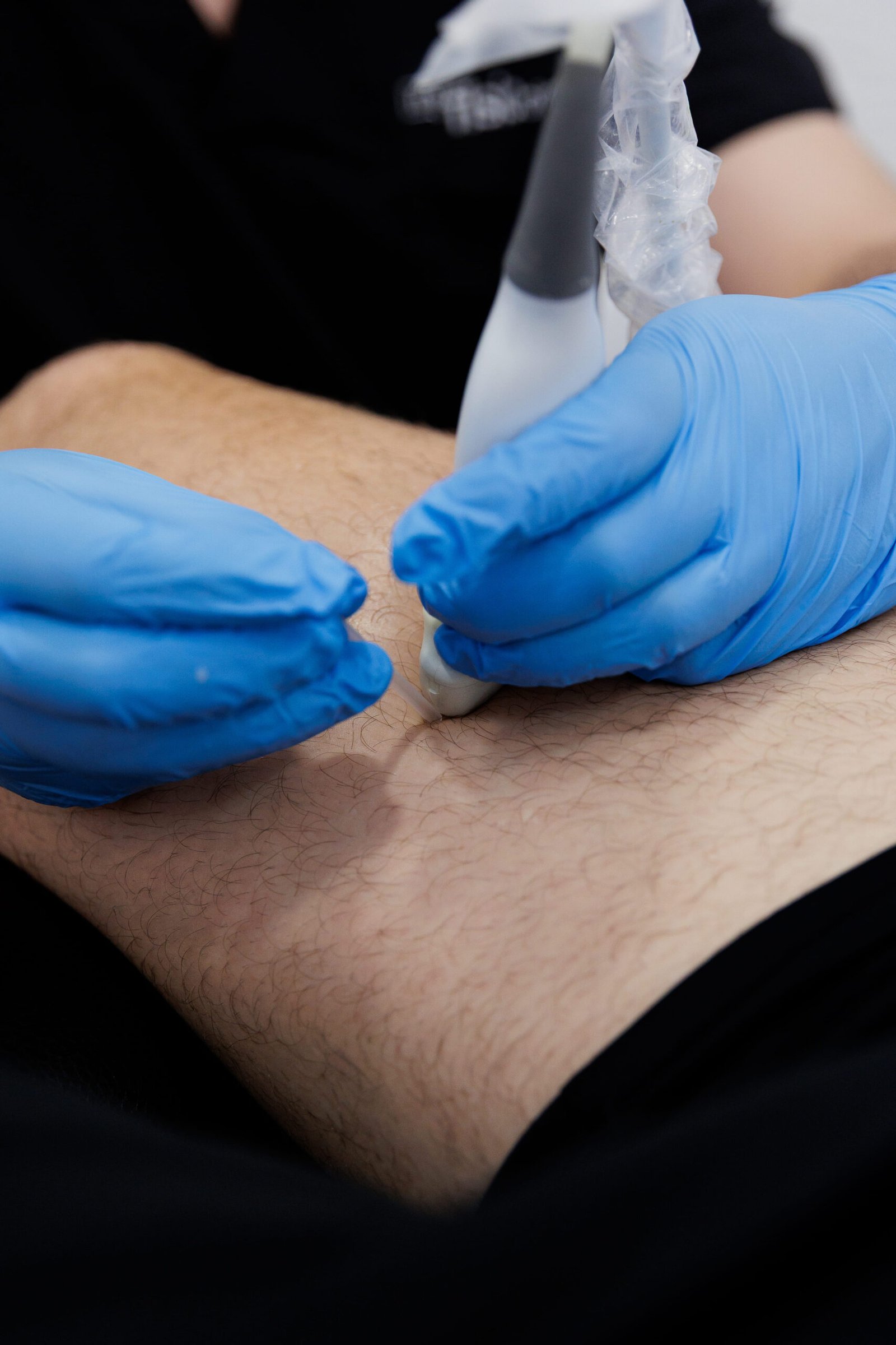 Fisioterapeuta con guantes aplicando punción seca en la pierna de un paciente en My Fisio Clinic, Vila-real